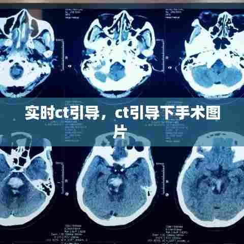 实时ct引导,ct引导下手术图片