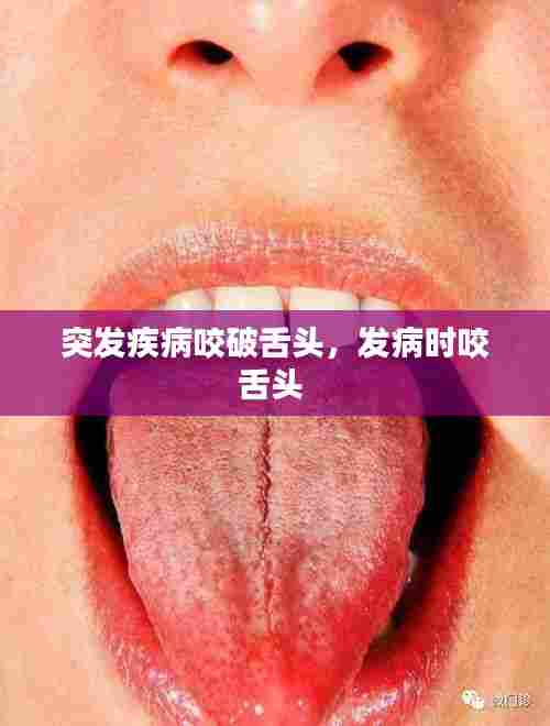 突发疾病咬破舌头，发病时咬舌头 