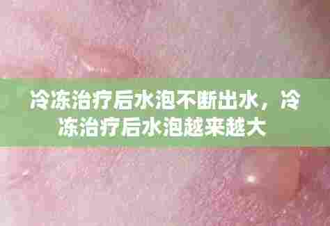 冷冻治疗后水泡不断出水,冷冻治疗后水泡越来越大